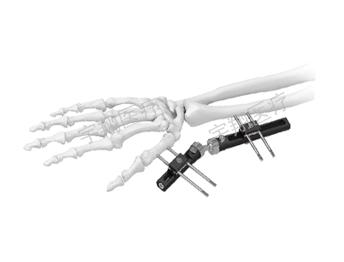 骨科外固定支架的使用规则