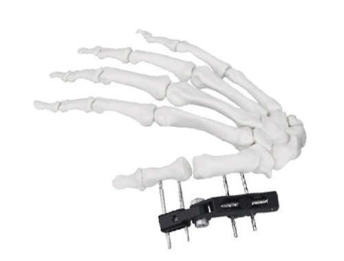 骨折后如何进行处理?