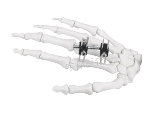 手指骨折的症状是怎样的？