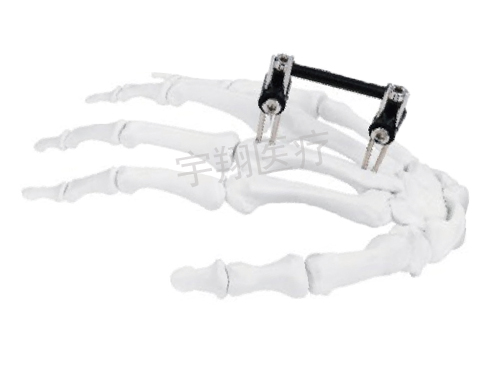 指掌骨支架组合型