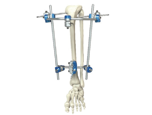 骨折治疗方法有哪几种？