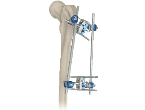 骨科外固定支架的代理资格分析