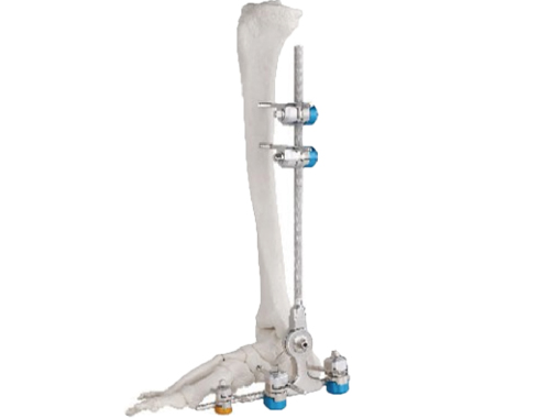 能够帮助骨折恢复的饮食疗法