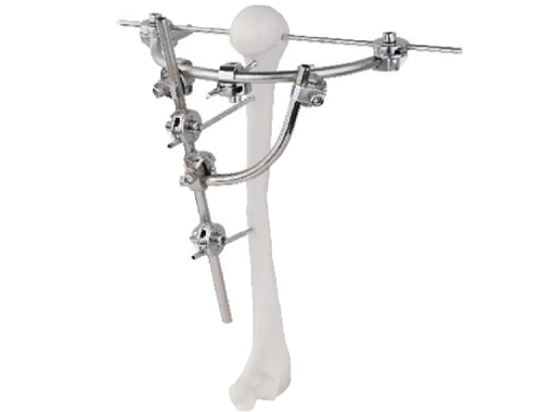 胫骨关节端（加强型）